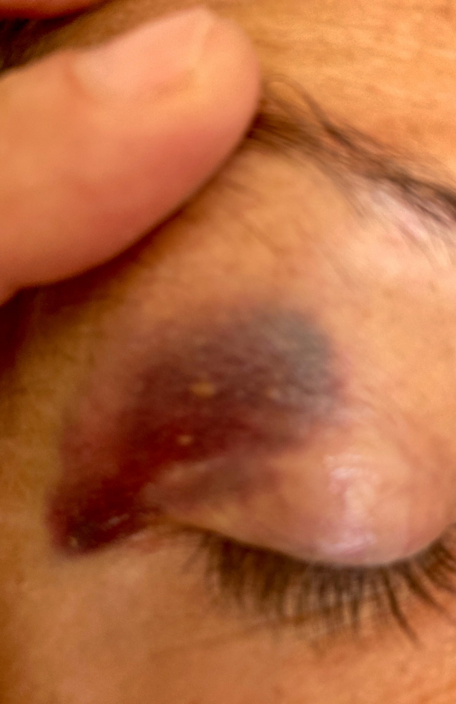 Black eye from Mosquito bite