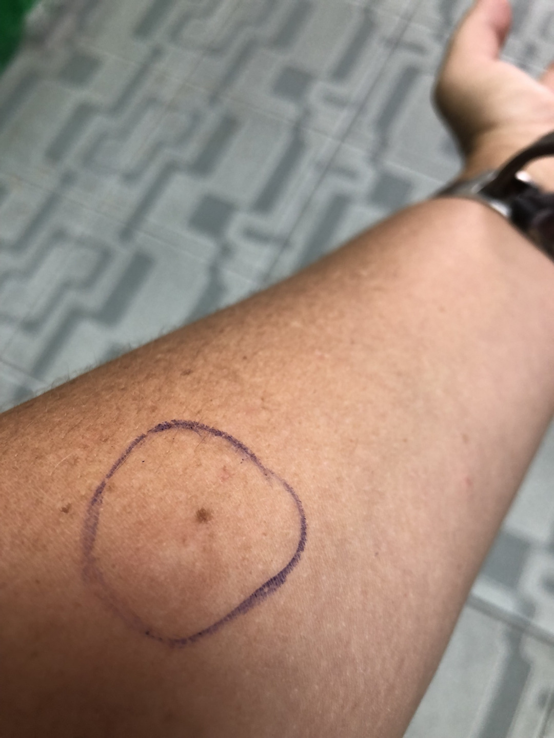 TB test